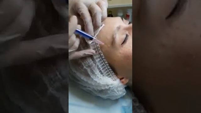 Биоревитализация Filorga (Fillmed) NCTF 135 HA. Клиника косметологии Доктора Дыбалюк. смотреть онлайн