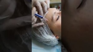 Биоревитализация Filorga (Fillmed) NCTF 135 HA. Клиника косметологии Доктора Дыбалюк.