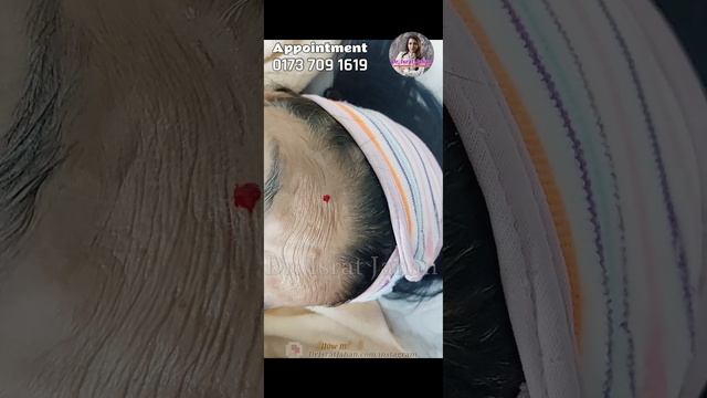 Forhead and messater muscle botox смотреть онлайн