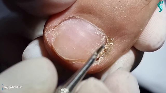 PACIENTE COM PEDRA NOS RINS QUEBROU A UNHA E DEU UM PUS SECO NO CANTO !! смотреть онлайн