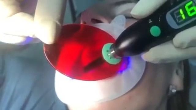 Временная пломба с OrthoFlow смотреть онлайн