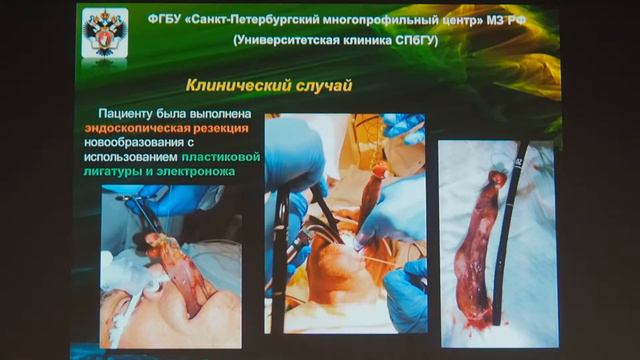 10 Сенчило СИ – Эндоскопическая резекция фиброзного полипа правой черпало надгортанной складки смотреть онлайн