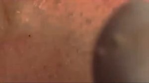 Выдавливание прыщей, угрей и черных точек