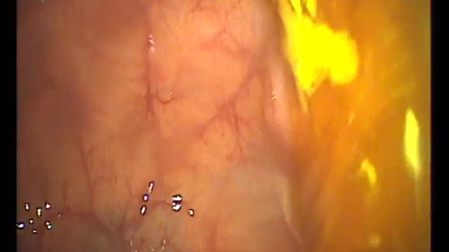 Колоноскопия в Мариуполе смотреть онлайн