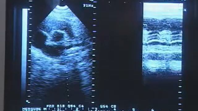 Ультразвуковое исследование сердца смотреть онлайн