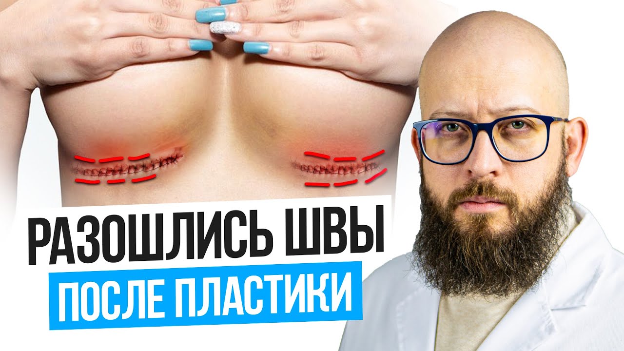 РАСХОЖДЕНИЕ ШВОВ ПОСЛЕ ОПЕРАЦИИ! Коррекция рубцов после операции смотреть онлайн