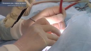 Стапедопластика