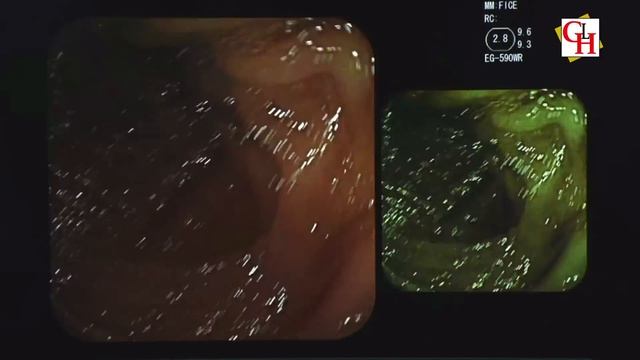 Endoscopy procedure in Hindi || Endoscopy की जांच विधि смотреть онлайн