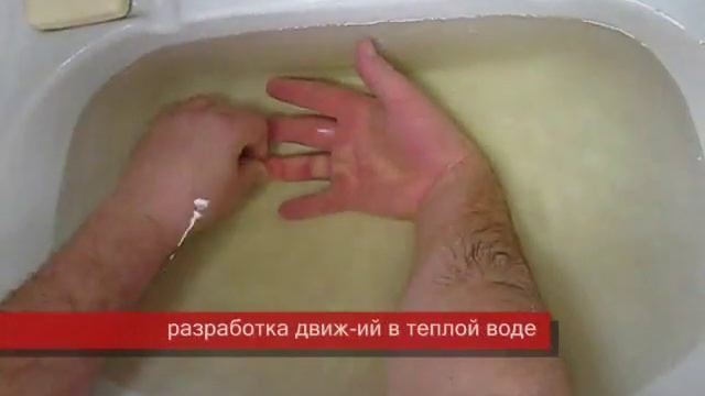 Контрактура Дюпюитрена IV степени DUPUYTREN.RU смотреть онлайн