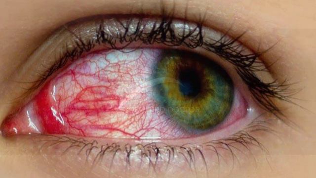 Best Eye Drops For Conjunctivitis | Eye Flu Ka Illaj | Tobradex Eye Drops| Eye Flu | Ashob E Chashm