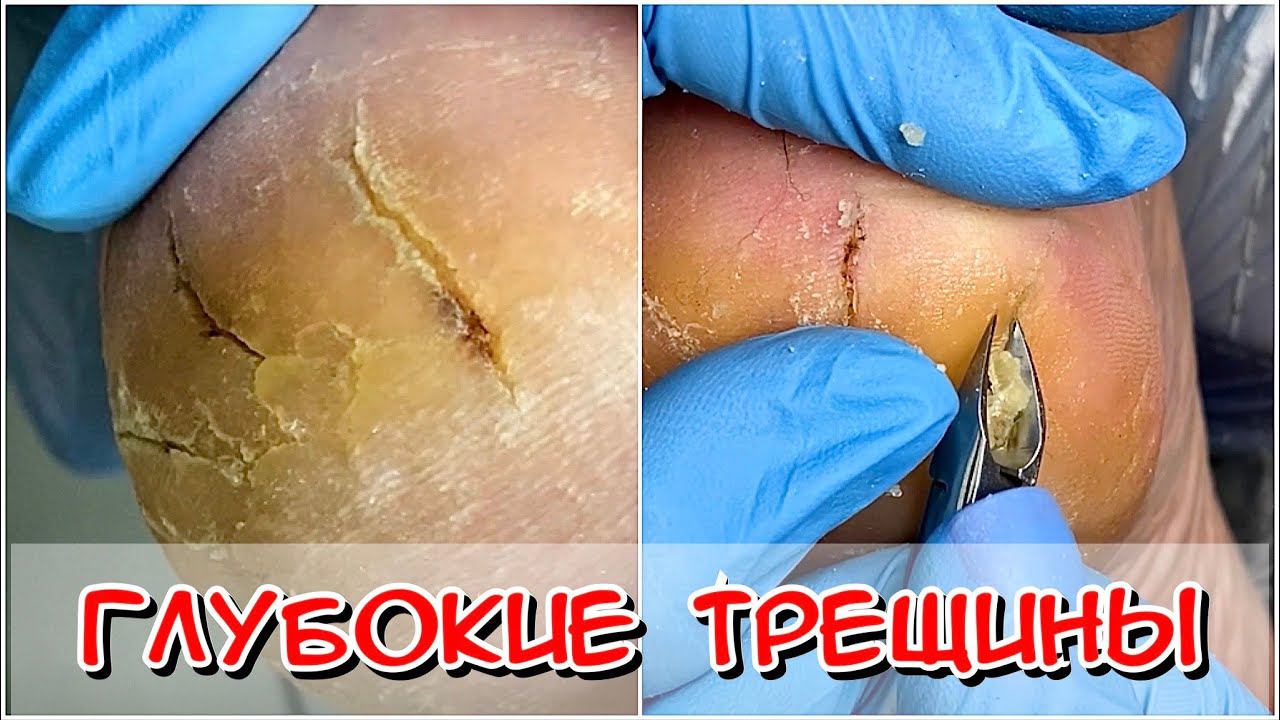 ГЛУБОКИЕ ТРЕЩИНЫ НА ПЯТКАХ / ТРЕЩИНЫ НА ПЯТКАХ НОГ / КАК УБРАТЬ ТРЕЩИНЫ НА ПЯТКАХ? / ЧТО ДЕЛАТЬ? смотреть онлайн