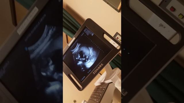 14 weeks Ultrasound смотреть онлайн