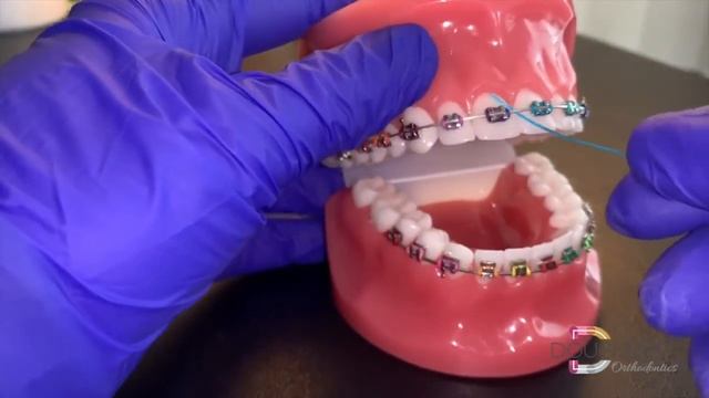 Flossing with Braces: Using a Floss Threader - Dougherty Orthodontics (St. Louis, Missouri) смотреть онлайн