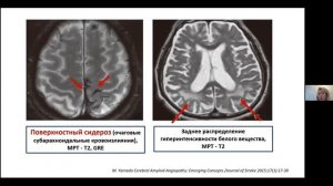 Ишемический инсульт.mp4