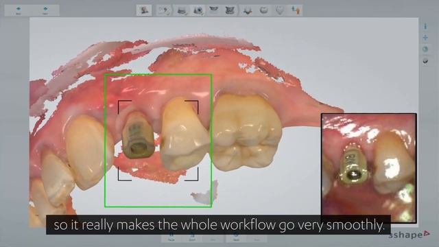 The implant scanning workflow with 3Shape TRIOS and 3Shape scan bodies – a lab’s impression смотреть онлайн