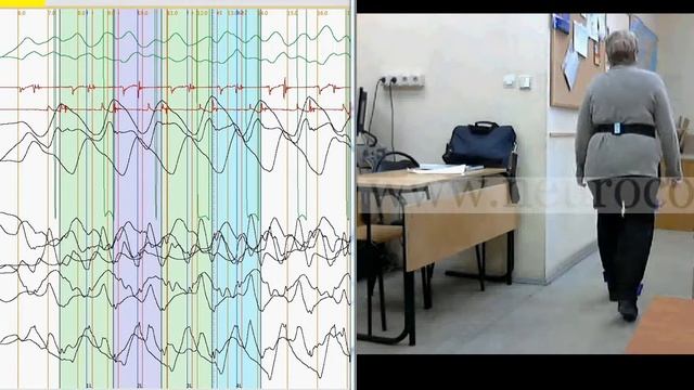 Двусторонний гонартроз