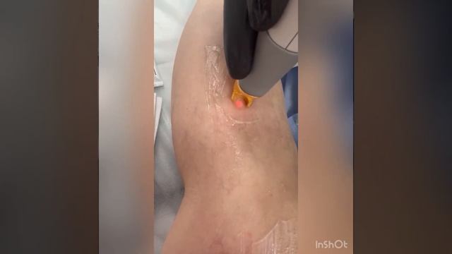 Laser Vascular от компании Cutera в работе. смотреть онлайн