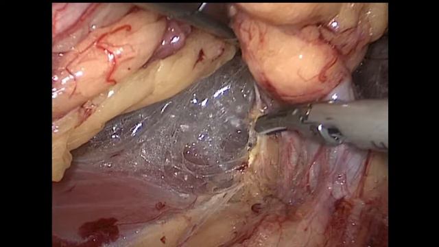 40 minutes Laparoscopic Right Nephrectomy / Лапароскопическая нефрэктомия справа смотреть онлайн