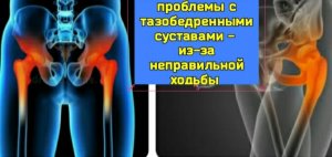 Почему спасение тазобедренных суставов - в правильной ходьбе? Как научиться правильной ходьбе?