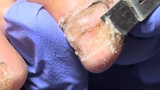Wow ~ super dirty nails, there is nothing under the nails【Doctor Liu Pedicure】 смотреть онлайн