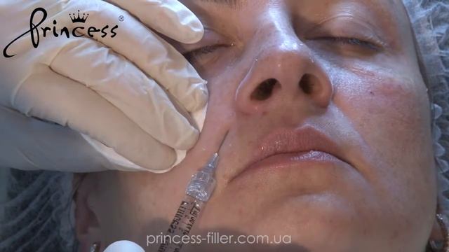 Коррекция средней трети лица и носогубной складки препаратом PRINCESS VOLUME CR 1 смотреть онлайн
