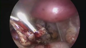 Лапароскопическое удаление эндометриоидной кисты