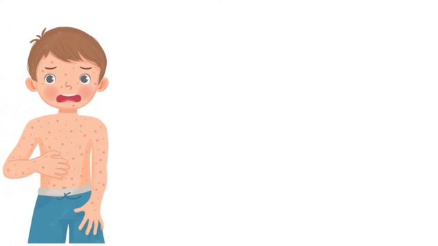 Chicken Pox Causes, Symptoms And Treatment