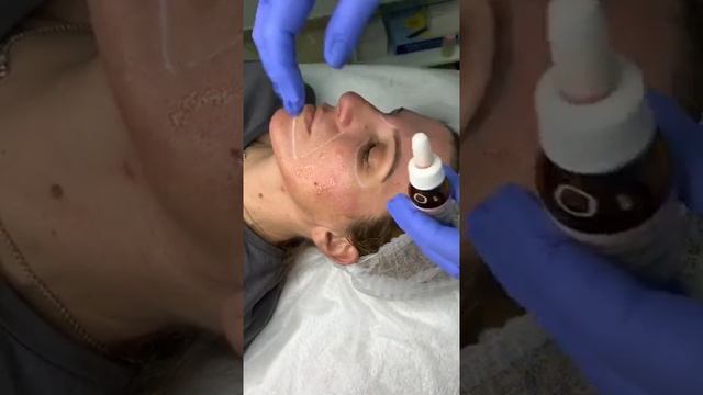 Нанесение химического пилинга смотреть онлайн