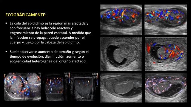 Conferencia 13: ROL DE LA ECOGRAFÍA EN EL ESCROTO AGUDO. смотреть онлайн