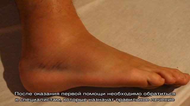 Вывих щиколотки смотреть онлайн