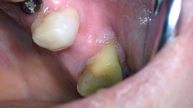 одномоментная имплантация и синуслифтинг