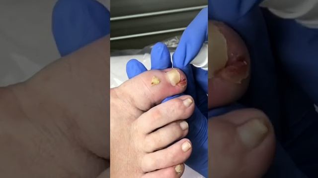 Вросший ноготь! Скорая помощь от Екатерины Зиминой смотреть онлайн