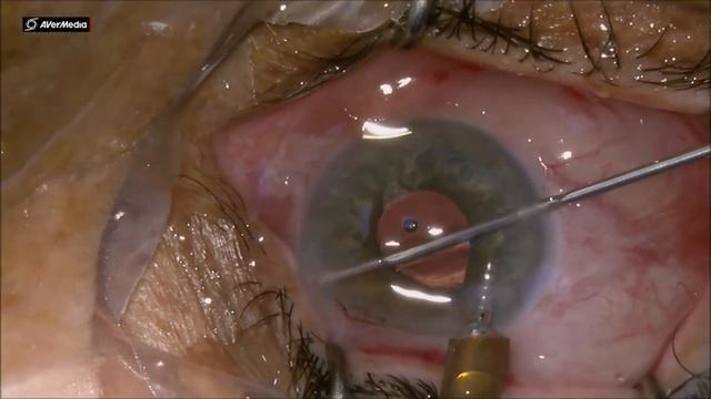 New Innovation, MIGS Ab-Interno Trabeculectomy for Glaucoma, post cataract surgery смотреть онлайн
