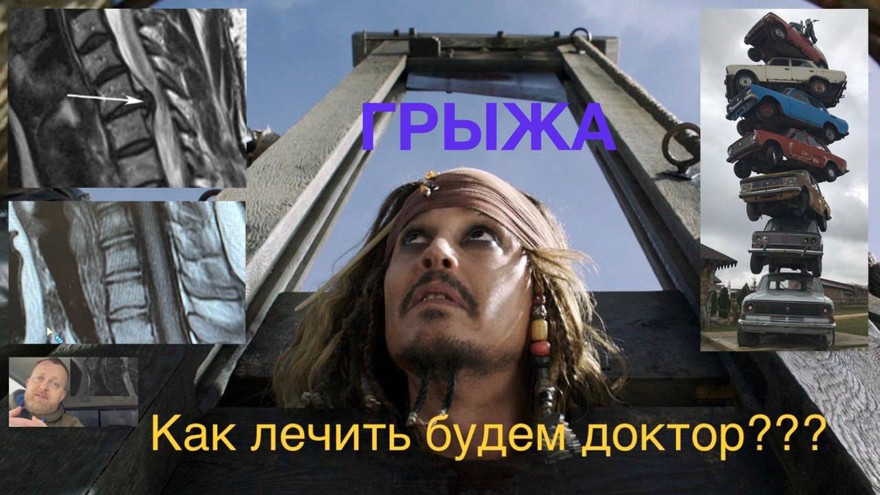 Грыжа в шее. Я - пациент