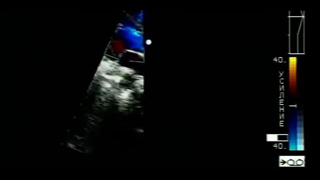 ДМЖП мышечной и мембранозной части. Видео 90-х годов. смотреть онлайн