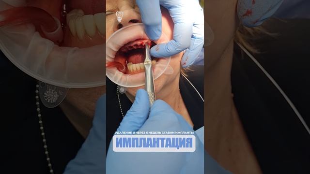 Удаление и через 6 недель ставим импланты. Removal And After 6 Weeks We'll Put Implants.
