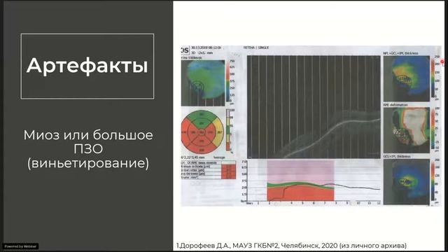 ОКТ при глаукоме. Ошибки сегментации, аномалии СНВС. смотреть онлайн