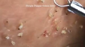 MULTIPLE Blackheads Removal #2 | Best Pimple Popping Videos 2020