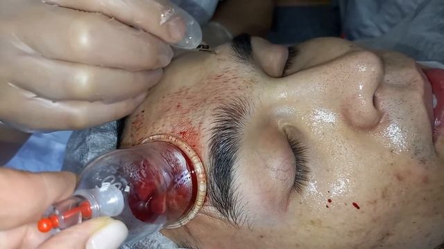 Хиджама на лицо 1 часть смотреть онлайн