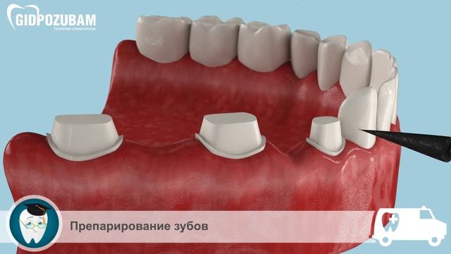 Мостовидные протезы: зубной мост для замещения нескольких зубов смотреть онлайн