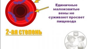 Варикозное расширение вен пищевода