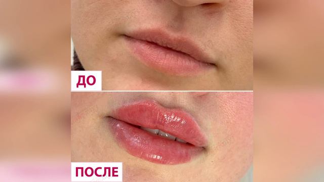 Результаты контурной пластики губ смотреть онлайн