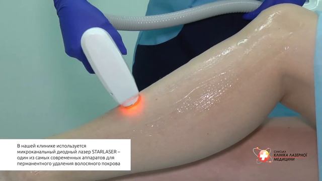 Лазерная эпиляция