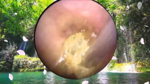 Удаление гигантского куска серы из уха | Гигантская серная пробкаЭндоскопическое лечение ушей