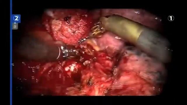 Rright Lower Lobe with lymph node dissection in N2 disease postCT смотреть онлайн
