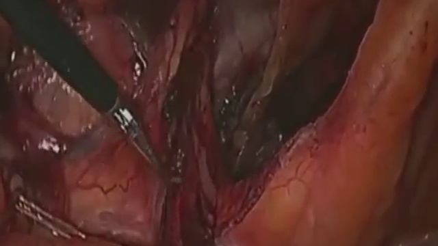 «TAPP с анатомическим имплантатом». Professor R. Bittner