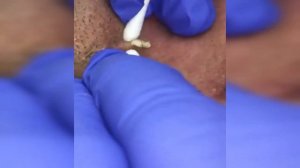 подборка выдавливания прыщей шорт 3 II выдавливание прыщей