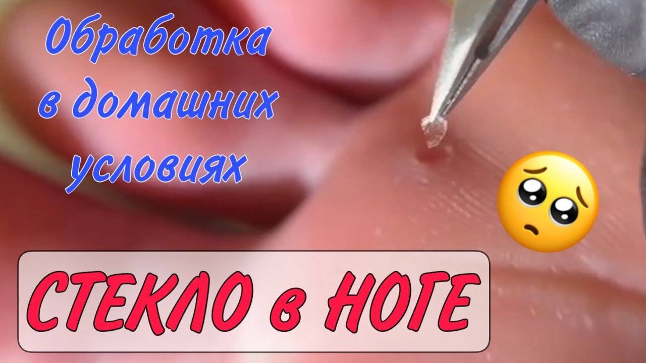 😱Стекло в ноге _ наступил на стекло _как убрать занозу смотреть онлайн