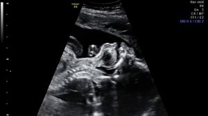 Малыш икает и глотает жидкость