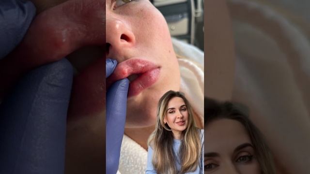 После инъекций / увеличения губ гель комкуется? Появляются шарики и шишки? Почему?эффект Тиндаля